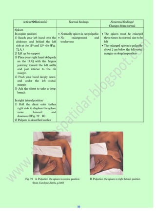 86
86
Action (✽Rationale) Normal findings Abnormal findings/
Changes from normal
Spleen
In supine position:
1) Reach your left hand over the
abdomen and behind the left
side at the 11th and 12th ribs (Fig.
72A. )
2) Lift up for support
3) Place your right hand obliquely
on the LUQ with the fingers
pointing toward the left axilla
and just inferior to the rib
margin
4) Push your hand deeply down
and under the left costal
margin
5) Ask the client to take a deep
breath
In right lateral position:
1) Roll the client onto his/her
right side to displace the spleen
more forward and
downward(Fig. 72 B.)
2) Palpate as described earlier
Normally spleen is not palpable
No enlargement and
tenderness
The spleen must be enlarged
three times its normal size to be
felt
The enlarged spleen is palpable
about 2 cm below the left costal
margin on deep inspiration
Fig. 72 A. Palpation the spleen in supine position B. Palpation the spleen in right lateral position
(from Carolyne Jarvis, p.583)
 