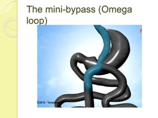 Fundamentals of bariatric and metabolic surgery | PPTX