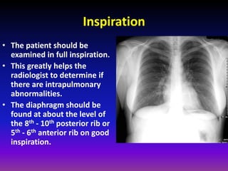 Inspiration Normal Ribs Fundamentals of chest radiology | PDF
