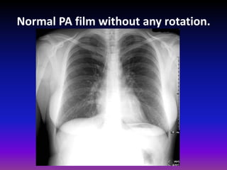 Fundamentals of chest radiology | PDF