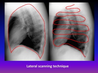 Lateral Scan Fundamentals of chest radiology | PDF