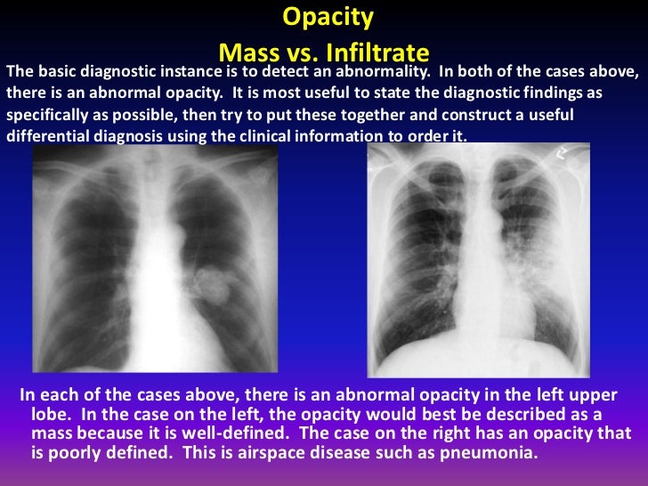 Fundamentals of chest radiology