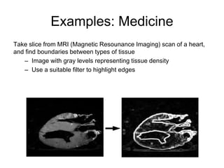 Examples: Medicine
Take slice from MRI (Magnetic Resounance Imaging) scan of a heart,
and find boundaries between types of tissue
– Image with gray levels representing tissue density
– Use a suitable filter to highlight edges
 