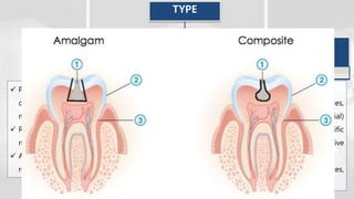 Mod Teeth Fundamentals of Cavity preparation | PPTX