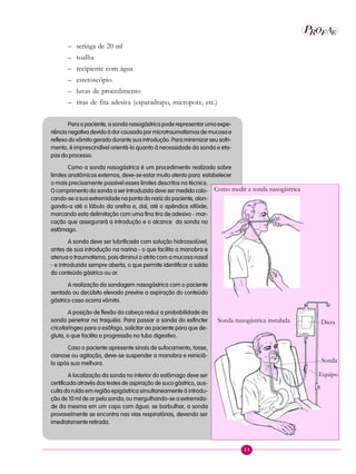 51
P E
A
ROF
– seringa de 20 ml
– toalha
– recipiente com água
– estetoscópio
– luvas de procedimento
– tiras de fita adesiva (esparadrapo, micropore, etc.)
Para o paciente, a sonda nasogástrica pode representar uma expe-
riência negativa devido à dor causada por microtraumatismos de mucosa e
reflexo do vômito gerado durante sua introdução. Para minimizar seu sofri-
mento, é imprescindível orientá-lo quanto à necessidade da sonda e eta-
pas do processo.
Como a sonda nasogástrica é um procedimento realizado sobre
limites anatômicos externos, deve-se estar muito atento para estabelecer
o mais precisamente possível esses limites descritos na técnica.
O comprimento da sonda a ser introduzida deve ser medido colo-
cando-se a sua extremidade na ponta do nariz do paciente, alon-
gando-a até o lóbulo da orelha e, daí, até o apêndice xifóide;
marcando esta delimitação com uma fina tira de adesivo - mar-
cação que assegurará a introdução e o alcance da sonda no
estômago.
A sonda deve ser lubrificada com solução hidrossolúvel,
antes de sua introdução na narina - o que facilita a manobra e
atenua o traumatismo, pois diminui o atrito com a mucosa nasal
- e introduzida sempre aberta, o que permite identificar a saída
do conteúdo gástrico ou ar.
A realização da sondagem nasogástrica com o paciente
sentado ou decúbito elevado previne a aspiração do conteúdo
gástrico caso ocorra vômito.
A posição de flexão da cabeça reduz a probabilidade da
sonda penetrar na traquéia. Para passar a sonda do esfíncter
cricofaríngeo para o esôfago, solicitar ao paciente para que de-
gluta, o que facilita a progressão no tubo digestivo.
Caso o paciente apresente sinais de sufocamento, tosse,
cianose ou agitação, deve-se suspender a manobra e reiniciá-
la após sua melhora.
A localização da sonda no interior do estômago deve ser
certificada através dos testes de aspiração de suco gástrico, aus-
culta do ruído em região epigástrica simultaneamente à introdu-
ção de 10 ml de ar pela sonda; ou mergulhando-se a extremida-
de da mesma em um copo com água: se borbulhar, a sonda
provavelmente se encontra nas vias respiratórias, devendo ser
imediatamente retirada.
Como medir a sonda nasogástrica
Sonda nasogástrica instalada Dieta
Sonda
Equipo
 