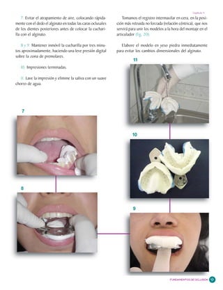 Capítulo 4

    7. Evitar el atrapamiento de aire, colocando rápida-         Tomamos el registro intermaxilar en cera, en la posi-
mente con el dedo el alginato en todas las caras oclusales   ción más retruida no forzada (relación céntrica), que nos
de los dientes posteriores antes de colocar la cuchari-      servirá para unir los modelos a la hora del montaje en el
lla con el alginato.                                         articulador (fig. 20).

   8 y 9. Mantener inmóvil la cucharilla por tres minu-         Elabore el modelo en yeso piedra inmediatamente
tos aproximadamente, haciendo una leve presión digital       para evitar los cambios dimensionales del alginato.
sobre la zona de premolares.
                                                                       11
   10. Impresiones terminadas.

   11. Lave la impresión y elimine la saliva con un suave
chorro de agua.




    7



                                                                      10




   8



                                                                       9




                                                                                              FUNDAMENTOS DE OCLUSIÓN    51
 