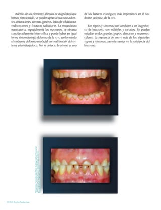 Además de los elementos clínicos de diagnóstico que                             de los factores etiológicos más importantes en el sín-
     hemos mencionado, se pueden apreciar fracturas (dien-                               drome doloroso de la ATM.
     tes, obturaciones, coronas, ganchos, áreas de soldaduras),
     reabsorciones y fracturas radiculares. La musculatura                                  Los signos y síntomas que conducen a un diagnósti-
     masticatoria, especialmente los maseteros, se observa                               co de bruxismo, son múltiples y variados. Se pueden
     considerablemente hipertrófica y puede haber en igual                               estudiar en dos grandes grupos: dentarios y neuromus-
     forma sintomatología dolorosa de la ATM, conformando                                culares. La presencia de uno o más de los siguientes
     el síndrome doloroso miofacial por mal función del sis-                             signos y síntomas, permite pensar en la existencia del
     tema estomatognático. Por lo tanto, el bruxismo es uno                              bruxismo.
                                Fotografías tomadas del Atlas de Diagnóstico Funcional
                                y PrincipiosTerapéuticos en Odontología, autores:
                                Axel Buhmann y Ulrich Lotzmann




C.D.M.O. Anselmo Apodaca Lugo
 
