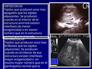 HIPOECOICAS
Tejidos que producen ecos mas
apagados que los tejidos
adyacentes. Se producen
cuando en el interior de la
estructura anormal existen
interfases de menor
ecogenicidad o en menor
número que en la estructura
normal que la circunda.
HIPERECOICAS
Tejidos que producen ecos mas
brillantes que los tejidos
adyacentes. Se producen
cuando en el interior de esa
estructura existen interfases
mayor ecogenicidad o en
mucho mayor número que en el
parénquima normal que la
 