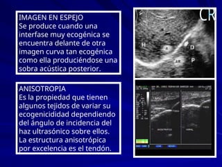 IMAGEN EN ESPEJO
Se produce cuando una
interfase muy ecogénica se
encuentra delante de otra
imagen curva tan ecogénica
como ella produciéndose una
sobra acústica posterior.
ANISOTROPIA
Es la propiedad que tienen
algunos tejidos de variar su
ecogenicididad dependiendo
del ángulo de incidencia del
haz ultrasónico sobre ellos.
La estructura anisotrópica
por excelencia es el tendón.
 