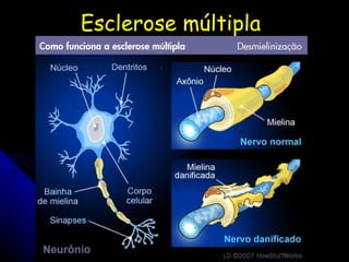 Esclerose múltipla 