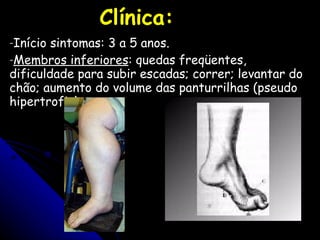 Clínica: Início sintomas: 3 a 5 anos. Membros inferiores : quedas freqüentes, dificuldade para subir escadas; correr; levantar do chão; aumento do volume das panturrilhas (pseudo hipertrofia); 