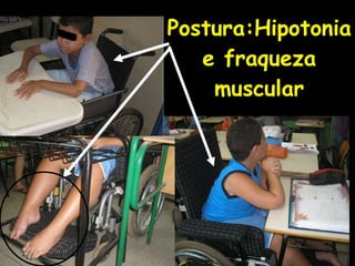 Postura:Hipotonia e fraqueza muscular 