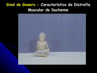 Sinal de Gowers -   Característico da Distrofia Muscular de Duchenne 