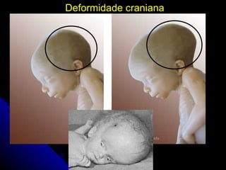 Deformidade craniana 