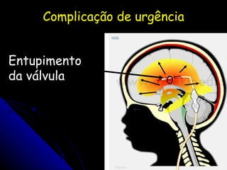 Complicação de urgência Entupimento  da válvula 