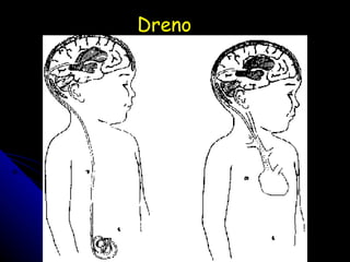 Dreno 