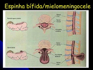 Espinha bífida/mielomeningocele 