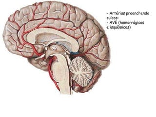 - Artérias preenchendo  sulcos:  - AVE (hemorrágicos e isquêmicos) 