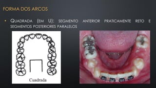• QUADRADA (EM U): SEGMENTO ANTERIOR PRATICAMENTE RETO E
SEGMENTOS POSTERIORES PARALELOS
FORMA DOS ARCOS
 