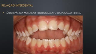 • DISCREPÂNCIA MUSCULAR : DESLOCAMENTO DA POSIÇÃO NEUTRA
RELAÇÃO INTERDENTAL
 