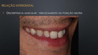 • DISCREPÂNCIA MUSCULAR : DESLOCAMENTO DA POSIÇÃO NEUTRA
RELAÇÃO INTERDENTAL
 