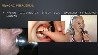• HÁBITOS PARAFUNCIONAIS: CHUPAR DEDO, CACHIMBO, INSTRUMENTOS
MUSICAIS
RELAÇÃO INTERDENTAL
 
