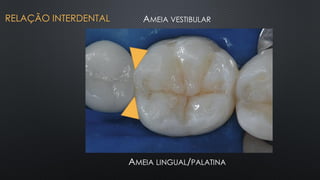 AMEIA LINGUAL/PALATINA
AMEIA VESTIBULAR
RELAÇÃO INTERDENTAL
 