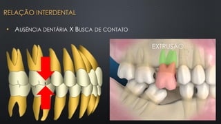 • AUSÊNCIA DENTÁRIA X BUSCA DE CONTATO
EXTRUSÃO
RELAÇÃO INTERDENTAL
 