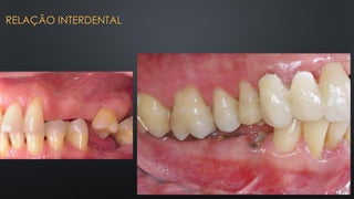 RELAÇÃO INTERDENTAL
 