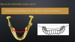RELAÇÃO DENTÁRIA INTRA-ARCO
CURVAS DE COMPENSAÇÃO DE WILSON : CURVA DE WILSON
 