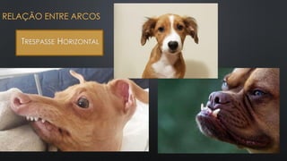 RELAÇÃO ENTRE ARCOS
TRESPASSE HORIZONTAL
 