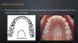 • PARABÓLICA: SEGMENTO ANTERIOR CURVADO COM LEVE DIVERGÊNCIA DOS
SEGMENTOS POSTERIORES
FORMA DOS ARCOS
 