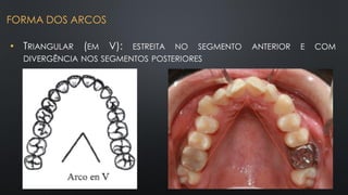 • TRIANGULAR (EM V): ESTREITA NO SEGMENTO ANTERIOR E COM
DIVERGÊNCIA NOS SEGMENTOS POSTERIORES
FORMA DOS ARCOS
 
