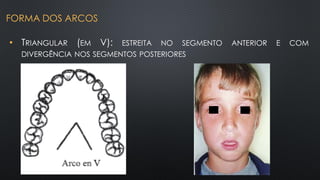 • TRIANGULAR (EM V): ESTREITA NO SEGMENTO ANTERIOR E COM
DIVERGÊNCIA NOS SEGMENTOS POSTERIORES
FORMA DOS ARCOS
 