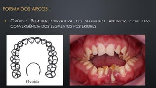 • OVÓIDE: RELATIVA CURVATURA DO SEGMENTO ANTERIOR COM LEVE
CONVERGÊNCIA DOS SEGMENTOS POSTERIORES
FORMA DOS ARCOS
 