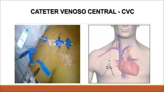 CATETER VENOSO CENTRAL - CVC
 