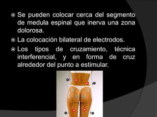 Se pueden colocar cerca del segmento
de medula espinal que inerva una zona
dolorosa.
 La colocación bilateral de electrodos.
 Los tipos de cruzamiento, técnica
interferencial, y en forma de cruz
alrededor del punto a estimular.


 