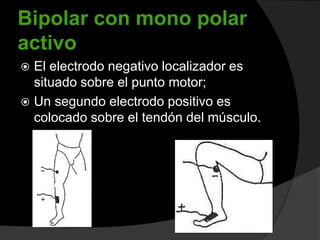 Bipolar con mono polar
activo
El electrodo negativo localizador es
situado sobre el punto motor;
 Un segundo electrodo positivo es
colocado sobre el tendón del músculo.


 