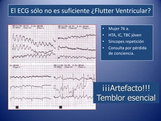 El ECG sólo no es suficiente ¿Flutter Ventricular?

                                •   Mujer 76 a.
                                •   HTA, IC, TBC jóven
                                •   Síncopes repetición
                                •   Consulta por pérdida
                                    de conciencia.




                               ¡¡¡Artefacto!!!
                              Temblor esencial
 