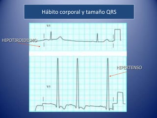 Hábito corporal y tamaño QRS



HIPOTIROIDISMO




                                            HIPERTENSO
 