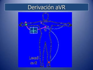 Derivación aVR
 