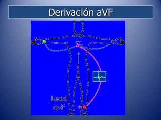 Derivación aVF
 