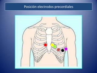 Posición electrodos precordiales
 