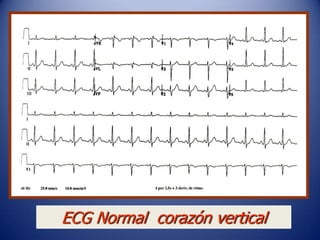 ECG Normal corazón vertical
 