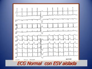 ECG Normal con ESV aislada
 