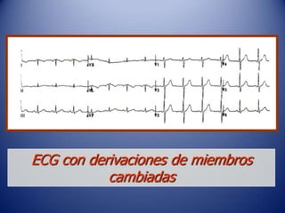 ECG con derivaciones de miembros
           cambiadas
 