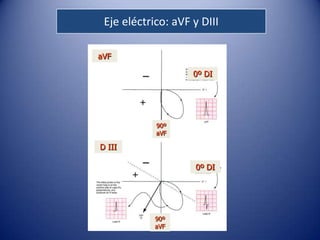 Eje eléctrico: aVF y DIII

aVF

                    0º DI




            90º
            aVF

D III

                     0º DI




            90º
            aVF
 