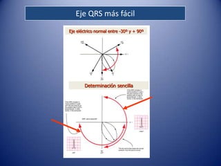 Eje QRS más fácil
Eje eléctrico normal entre -30º y + 90º




        Determinación sencilla
 