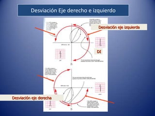Desviación Eje derecho e izquierdo

                                     Desviación eje izquierda




                                    DI




Desviación eje derecha
 