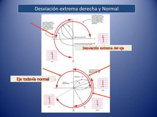 Desviación extrema derecha y Normal




                             Desviación extrema del eje




Eje todavía normal
 